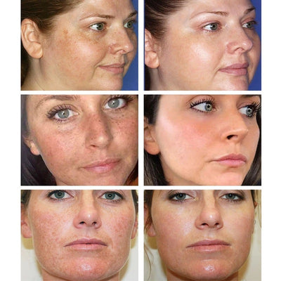 Whitening And Freckle Removing Cream Fade Spots Gently