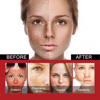 Repair Facial Dark Spots And Freckles