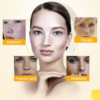 Whitening And Freckle Removing Cream Fade Spots Gently